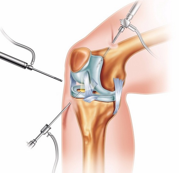 Артроскопия сустава: когда ее делают?